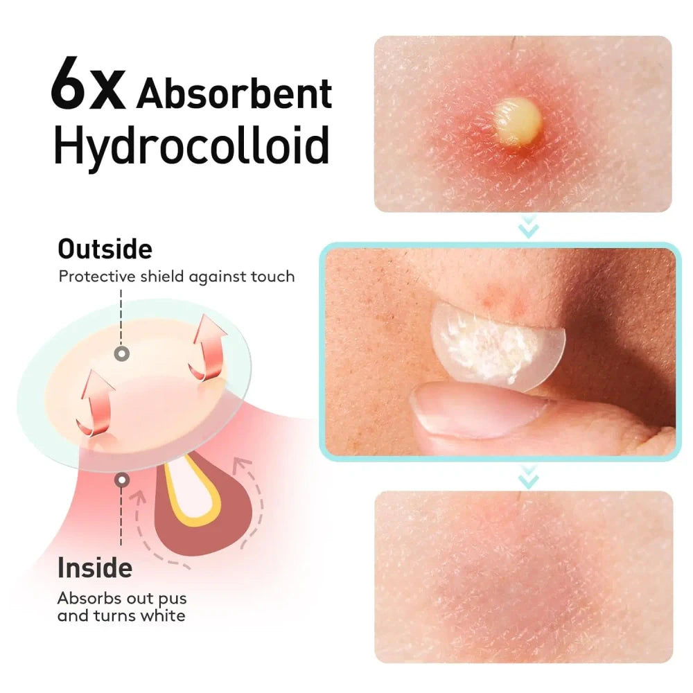 Salicylic Acid Acne Patches